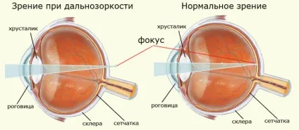 Далекозорість у дітей причини, різновиди і лікування