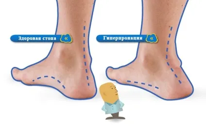 деформація Хаглунд