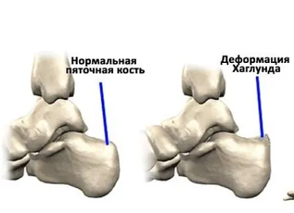 деформація Хаглунд
