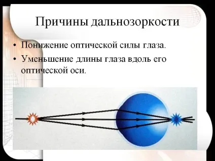 Далекозорість у дітей - причини, симптоми і лікування у дитини