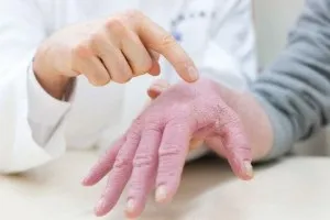 Дерматологічні захворювання види, характеристики та лікування (дерматологічні) Дерматологічні захворювання види, характеристики та лікування