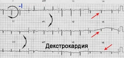 Декстрокардія її особливості і причини (особливо) Декстрокардія її особливості і причини