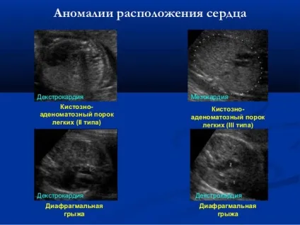 Декстрокардія серця - що це таке, ЕКГ, у плода, з транспозицією органів, як часто зустрічається (декстрокардія) Декстрокардія серця - що це таке, ЕКГ, у плода, з транспозицією органів, як часто зустрічається
