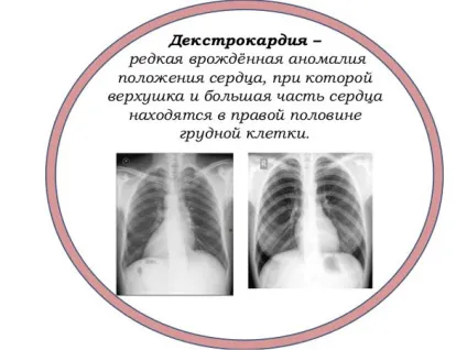 Декстрокардія серця - що це таке, ЕКГ, у плода, з транспозицією органів, як часто зустрічається (серця) Декстрокардія серця - що це таке, ЕКГ, у плода, з транспозицією органів, як часто зустрічається