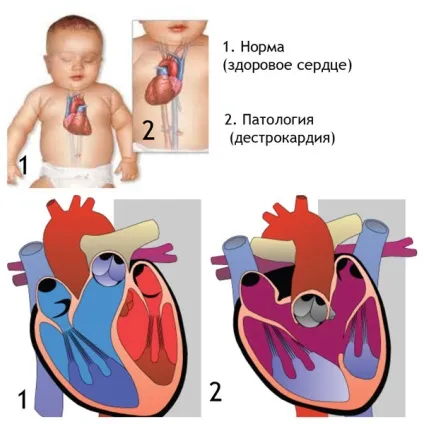 Декстрокардія серця - що це таке, ЕКГ, у плода, з транспозицією органів, як часто зустрічається (серця) Декстрокардія серця - що це таке, ЕКГ, у плода, з транспозицією органів, як часто зустрічається