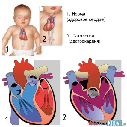 Декстрокардія причини, симптоми, діагностика на ЕКГ, лікування та ускладнення (діагностика) Декстрокардія причини, симптоми, діагностика на ЕКГ, лікування та ускладнення