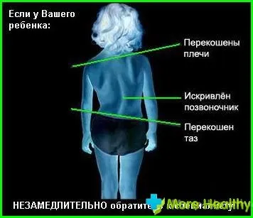 Дитячий сколіоз в картинках