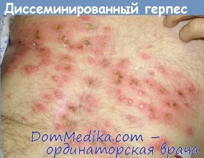 Дисемінована форма герпесвірусної інфекції - діагностика, лікування (герпесвирусной) Дисемінована форма герпесвірусної інфекції - діагностика, лікування
