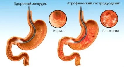 Дієта при гастродуоденіті меню, лікарські рекомендації