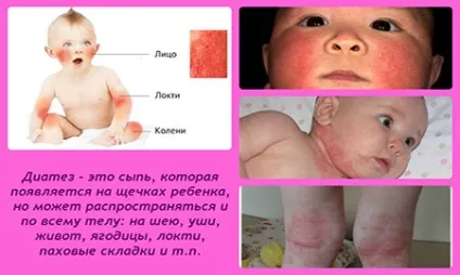 Діатез у немовлят лікування (діатез) Діатез у немовлят лікування