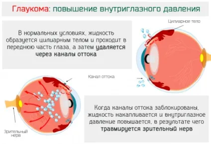 Який нормальний очний тиск при глаукомі симптоми і лікування зниженого і підвищеного, як (симптоми) Який нормальний очний тиск при глаукомі симптоми і лікування зниженого і підвищеного, як