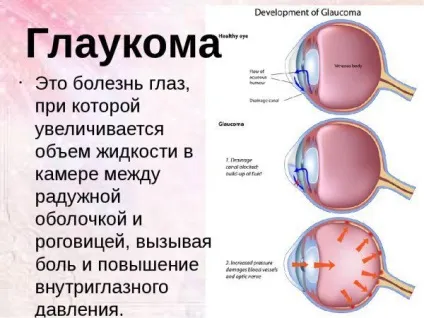 Який нормальний очний тиск при глаукомі симптоми і лікування зниженого і підвищеного, як (глаукомі) Який нормальний очний тиск при глаукомі симптоми і лікування зниженого і підвищеного, як