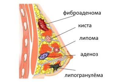 Доброякісна пухлина молочної залози різновиди і методи лікування (залози) Доброякісна пухлина молочної залози різновиди і методи лікування