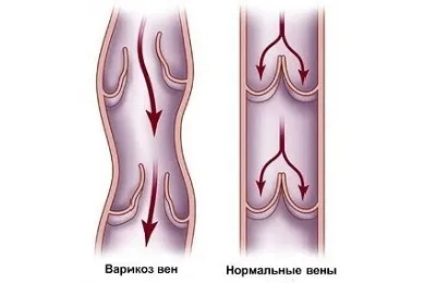 Дуплексне сканування вен нижніх кінцівок що це таке і для чого проводиться (дуплексне) Дуплексне сканування вен нижніх кінцівок що це таке і для чого проводиться