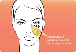 Ендоскопічна підтяжка обличчя - процедура, відгуки, фото і відео