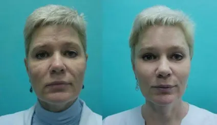 Ендоскопічна підтяжка обличчя - процедура, відгуки, фото і відео