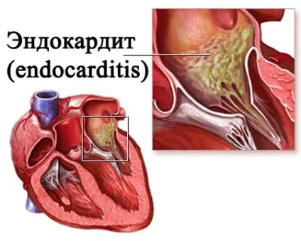 Ендокардит що це таке, симптоми і лікування