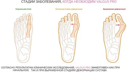 Фіксатор кісточки на великому пальці ноги відгуки, ефективність, переваги та недоліки (відгуки) Фіксатор кісточки на великому пальці ноги відгуки, ефективність, переваги та недоліки