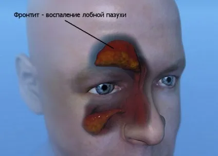 Фронтит симптоми, класифікація, лікування гострого і хронічного фронтита медикаментами і за допомогою (фронтит) Фронтит симптоми, класифікація, лікування гострого і хронічного фронтита медикаментами і за допомогою