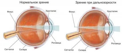 Гіперметропія у дітей до року і більше середньої, високого ступеня причини далекозорості, корекція (дітей) Гіперметропія у дітей до року і більше середньої, високого ступеня причини далекозорості, корекція