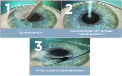 Гіперметропія у дітей до року і більше середньої, високого ступеня причини далекозорості, корекція (дітей) Гіперметропія у дітей до року і більше середньої, високого ступеня причини далекозорості, корекція