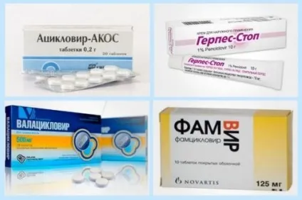 Герпес на голові симптоми, ознаки, лікування (герпес голові волоссі) Герпес на голові симптоми, ознаки, лікування