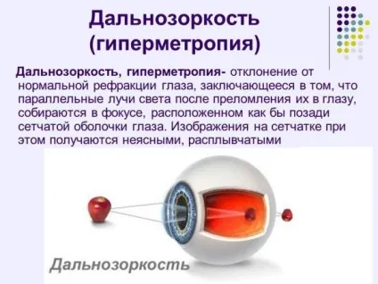Гіперметропія у дітей до року і більше середньої, високого ступеня причини далекозорості, корекція (високої) Гіперметропія у дітей до року і більше середньої, високого ступеня причини далекозорості, корекція