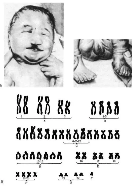 Геномний рівень і біологічна мінливість (хворого каріотип хворого) Геномний рівень і біологічна мінливість