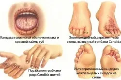 Грибок у дітей симптоми і лікування (симптоми) Грибок у дітей симптоми і лікування
