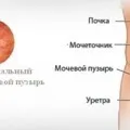 Інстиляція сечового міхура у жінок і чоловіків, переваги та недоліки методу (жінок) Інстиляція сечового міхура у жінок і чоловіків, переваги та недоліки методу