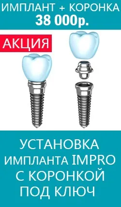 Імплантація жувальних зубів, ціна, відразу після видалення (зубів) Імплантація жувальних зубів, ціна, відразу після видалення