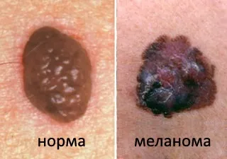 Імунотерапія при меланомі хіміотерапія, нове в лікуванні, методи (хіміотерапія) Імунотерапія при меланомі хіміотерапія, нове в лікуванні, методи
