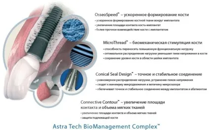 Імпланти astra tech (астра тек) види, технології, відгуки, переваги, ціна (astra) Імпланти astra tech (астра тек) види, технології, відгуки, переваги, ціна
