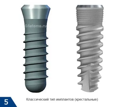 Імпланти і куріння - чи можна курити до чи після операції, наслідки (можна) Імпланти і куріння - чи можна курити до чи після операції, наслідки