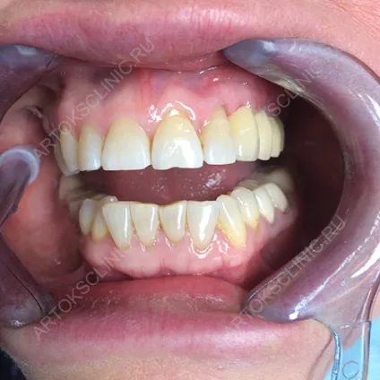 Імплантація нижніх зубів (імпланти нижньої щелепи) (зубів) Імплантація нижніх зубів (імпланти нижньої щелепи)