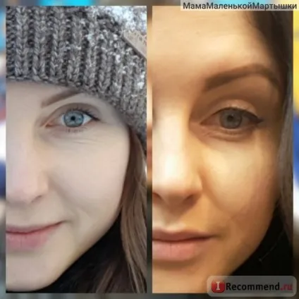 Ін'єкції ботокса - «прощай, старенька! Або як перемогти мімічні зморшки навколо очей (ін'єкції) Ін'єкції ботокса - «прощай, старенька! Або як перемогти мімічні зморшки навколо очей