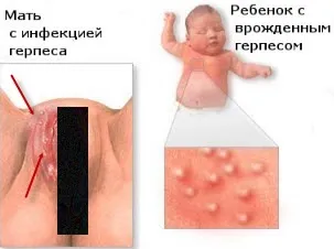 Як передається оперізуючий герпес і передається чи з'ясуємо (оперізувальний) Як передається оперізуючий герпес і передається чи з'ясуємо
