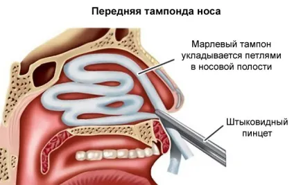 Як зупинити кров з носа самостійно, коли йти до лікаря (самостійно) Як зупинити кров з носа самостійно, коли йти до лікаря