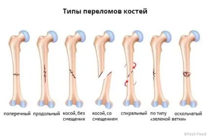 Як визначити забій або перелом (перелом) Як визначити забій або перелом