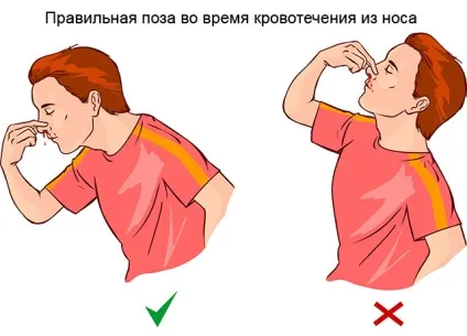Як зупинити кров з носа самостійно, коли йти до лікаря (самостійно) Як зупинити кров з носа самостійно, коли йти до лікаря