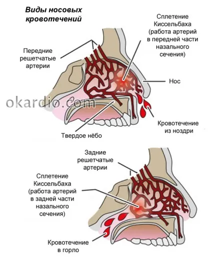 Як зупинити кров з носа самостійно, коли йти до лікаря (кров) Як зупинити кров з носа самостійно, коли йти до лікаря