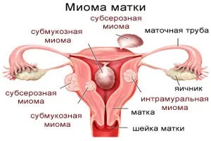 Інтрамуральна міома матки - що це таке, причини, симптоми, лікування, фото