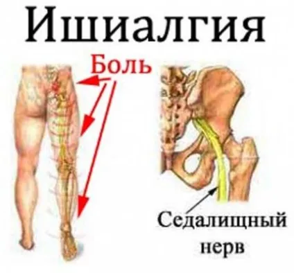 Ішіалгія симптоми і лікування (симптоми ішіалгії сідничного нерва лікування ішіалгії) Ішіалгія симптоми і лікування