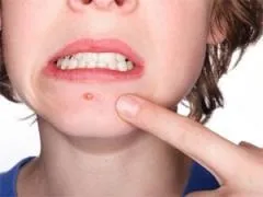 Як швидко зняти почервоніння після прища на обличчі (прища) Як швидко зняти почервоніння після прища на обличчі