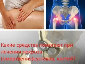 Які засоби допомагають при лікуванні некрозу (омертвіння) суглобів, кісток, мій знахар (некроз кісток) Які засоби допомагають при лікуванні некрозу (омертвіння) суглобів, кісток, мій знахар