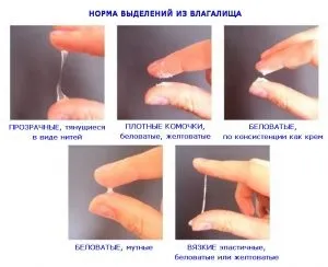 Які виділення при молочниці як виглядають якого кольору, фото (молочниці) Які виділення при молочниці як виглядають якого кольору, фото