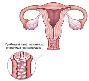 Які виділення при молочниці як виглядають якого кольору, фото (якого) Які виділення при молочниці як виглядають якого кольору, фото