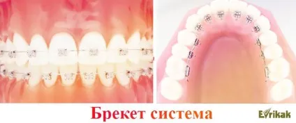 Які брекети краще вибрати