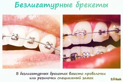 Які брекети краще вибрати