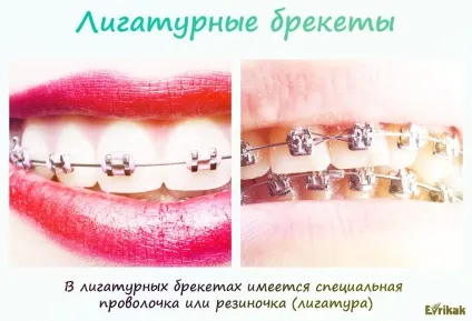 Які брекети краще вибрати